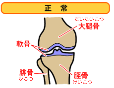 変形性膝関節症 01