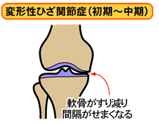 変形性膝関節症 02